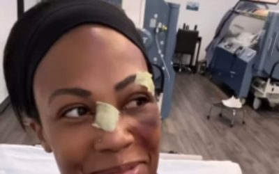 Model & Olympian Kim Glass used HBOT to recover from facial injuries