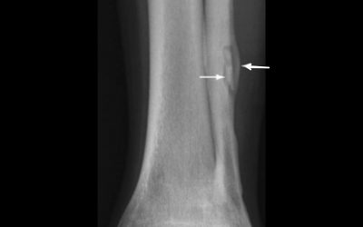 HBOT Described as ‘Crucial Tool’ for Treatment of Osteomyelitis